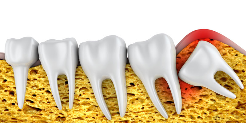 check in with your dentist about wisdom teeth removal