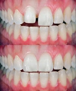 Veneers can quickly make your teeth whiter