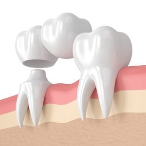 crowns & bridges are long-lasting solutions to major dental challenges