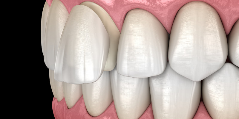 Tooth Bonding in Walkertown, North Carolina