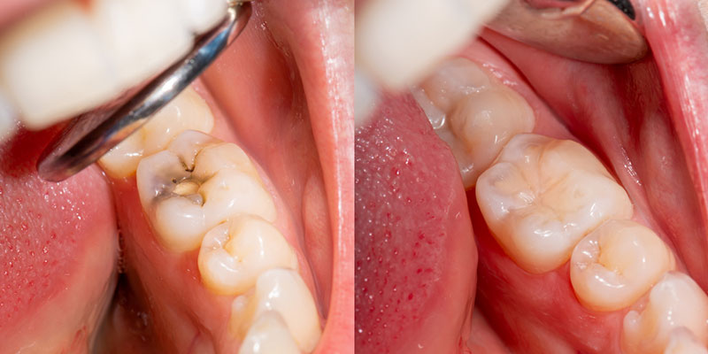 Composite Restorations in Walkertown, North Carolina